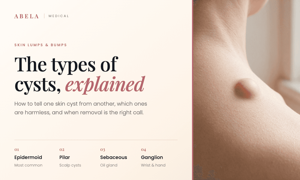 Types of skin cysts explained by Abela Medical