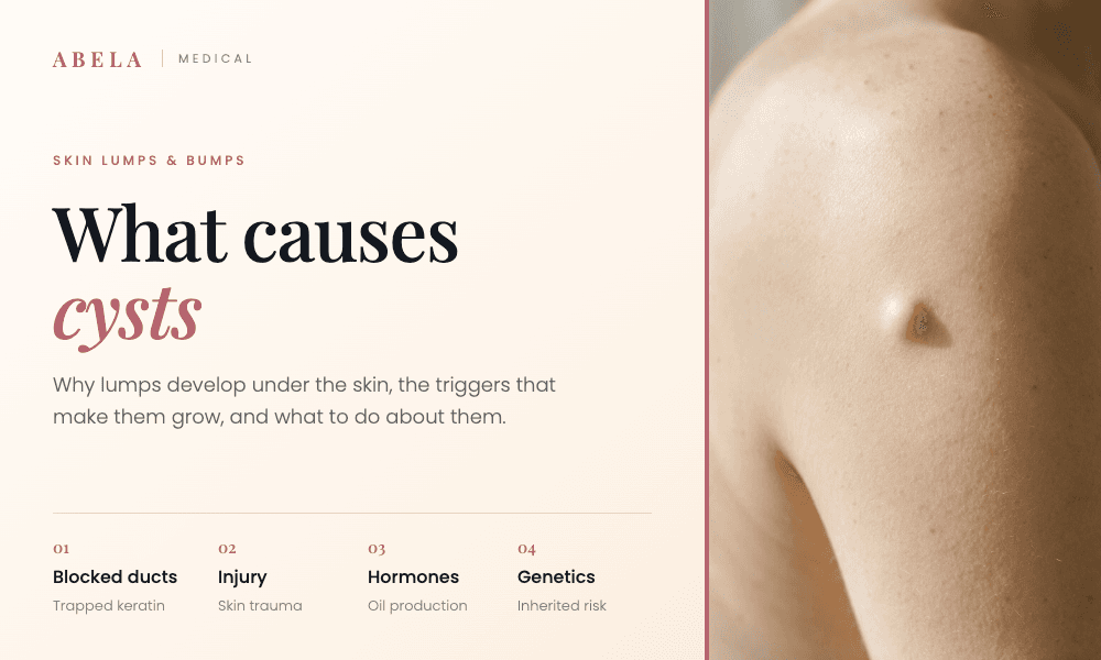 What causes cysts to form, explained by Abela Medical